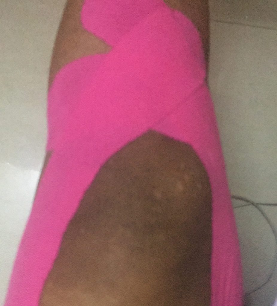 Bandaged leg due to calcium and iron deficiency.